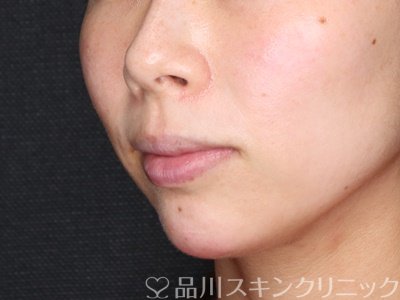 症例NO.71342のAFTER写真