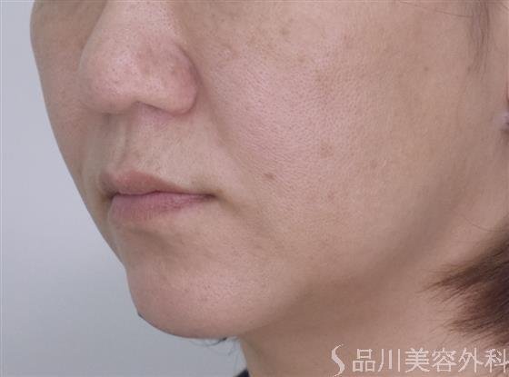 症例NO.50469のBEFORE写真