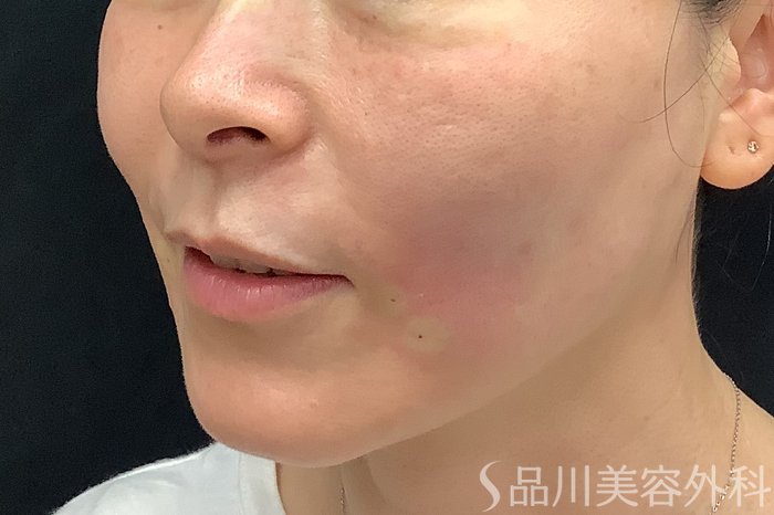 症例NO.71252のAFTER写真