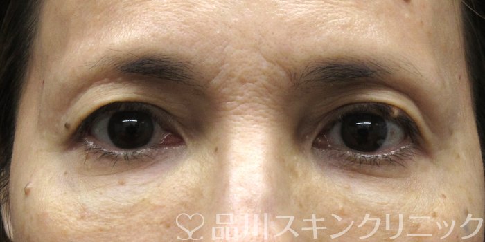 症例NO.74519のBEFORE写真