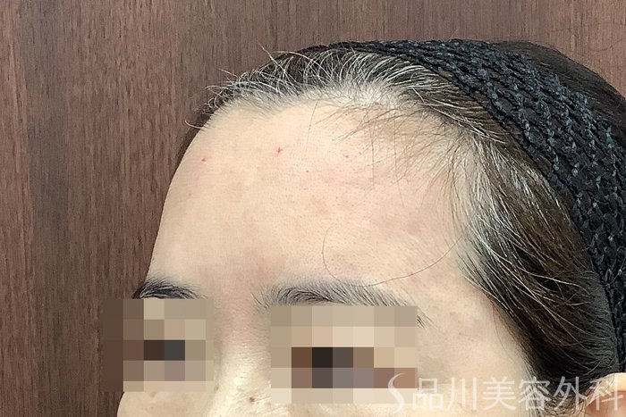 症例NO.67780のAFTER写真