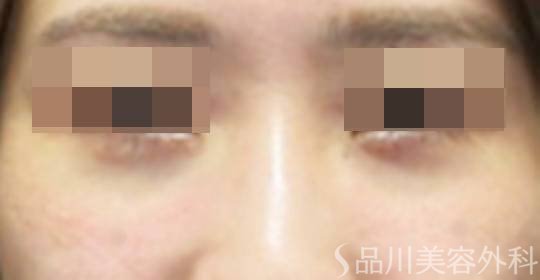 症例NO.74466のAFTER写真
