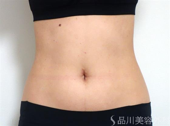 症例NO.35000のAFTER写真