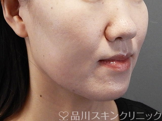 症例NO.71600のBEFORE写真