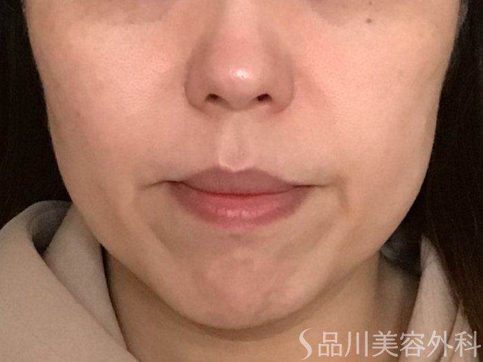 症例NO.65282のBEFORE写真