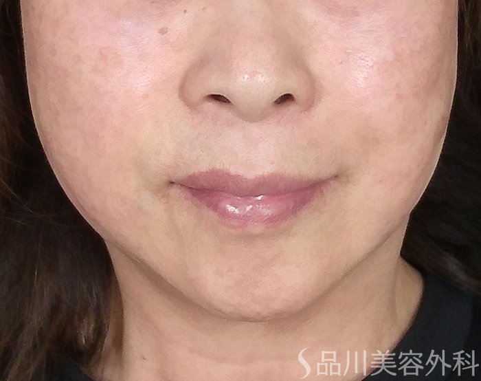 症例NO.65436のAFTER写真