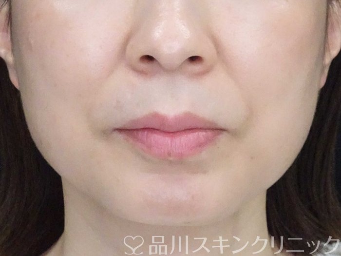症例NO.62234のBEFORE写真