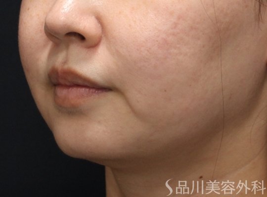 症例NO.75180のBEFORE写真