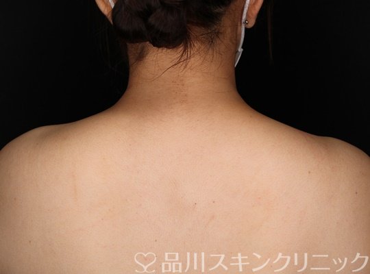 症例NO.70187のAFTER写真