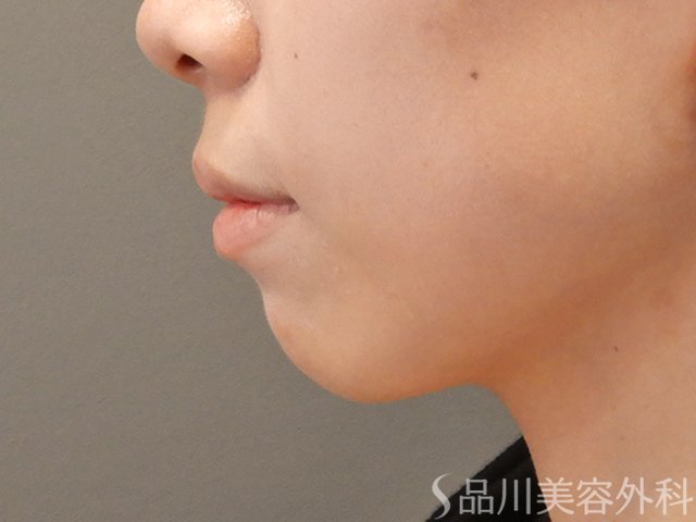 症例NO.72718のBEFORE写真