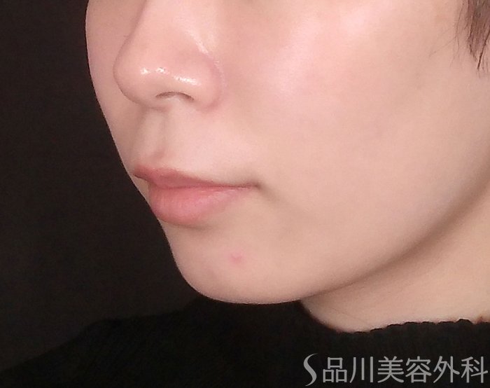 症例NO.70667のBEFORE写真