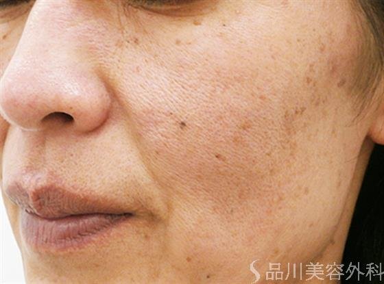 症例NO.23671のBEFORE写真