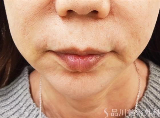 症例NO.32107のBEFORE写真