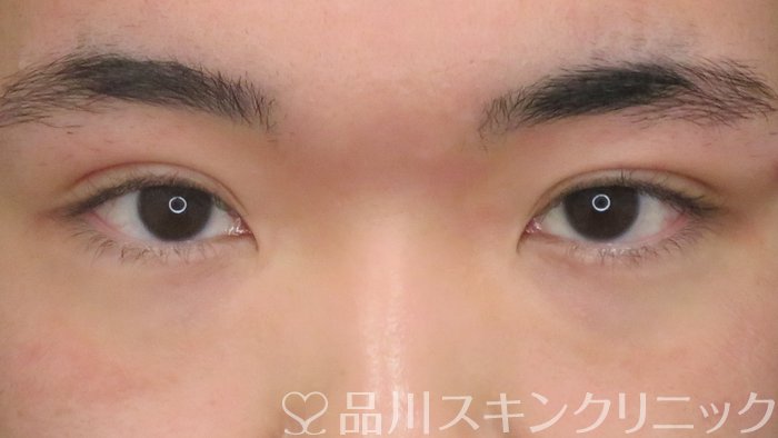 症例NO.69553のAFTER写真