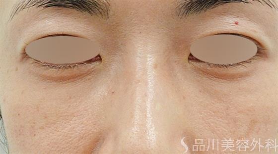 症例NO.49211のAFTER写真