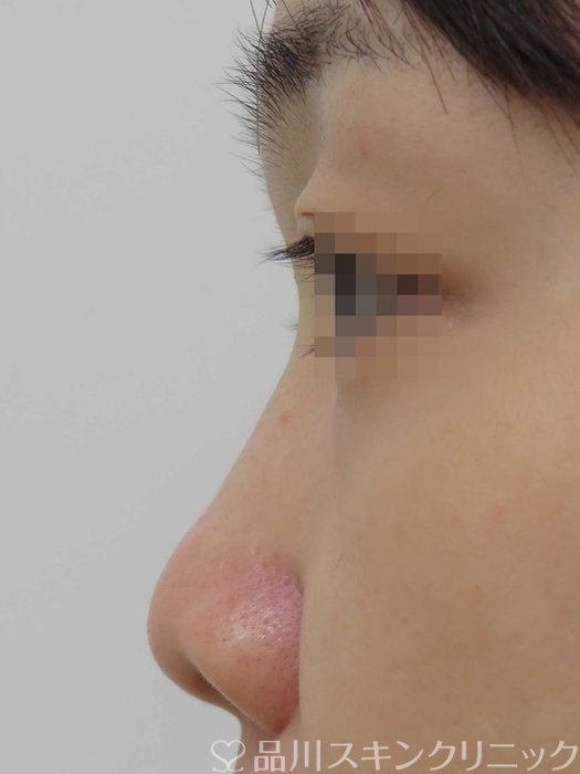 症例NO.71220のBEFORE写真