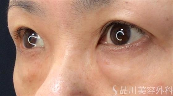 症例NO.59176のBEFORE写真