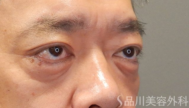 症例NO.75042のAFTER写真