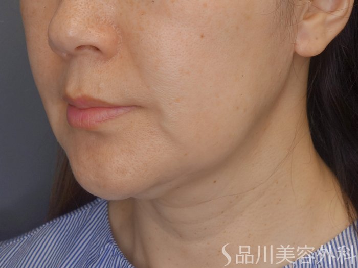 症例NO.70327のBEFORE写真