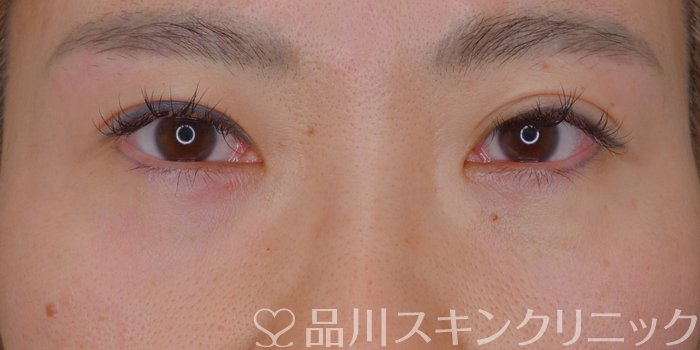 症例NO.73299のAFTER写真