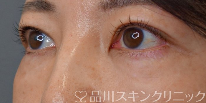 症例NO.72417のBEFORE写真