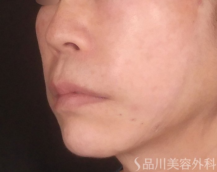 症例NO.70979のAFTER写真