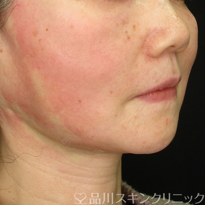 症例NO.69702のAFTER写真
