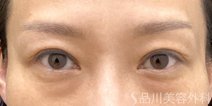 症例NO.70242のAFTER写真
