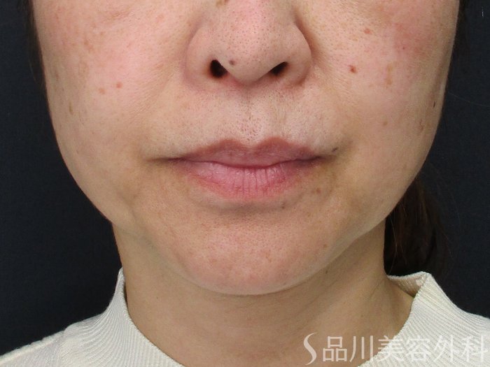 症例NO.69569のBEFORE写真