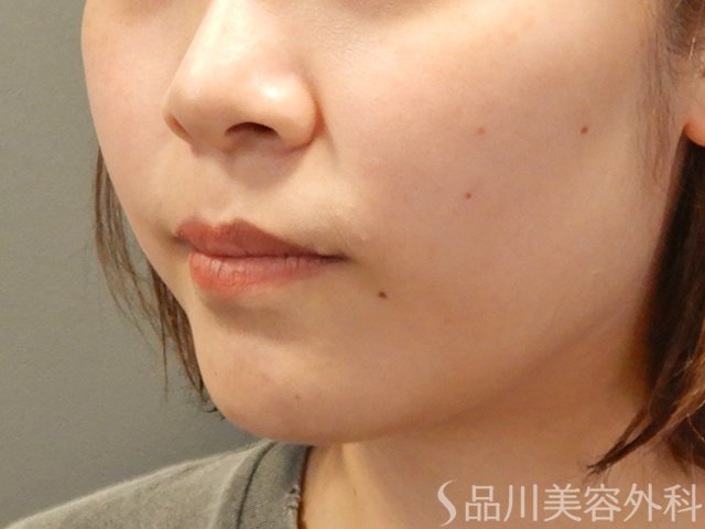 症例NO.71798のBEFORE写真