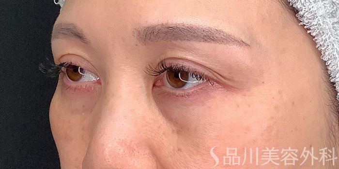 症例NO.71229のBEFORE写真