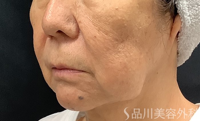 症例NO.67983のBEFORE写真