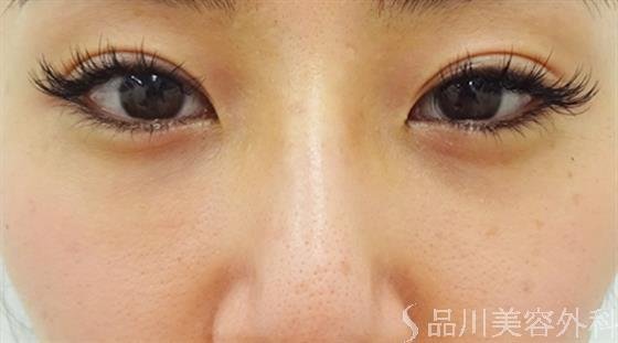 症例NO.39668のAFTER写真