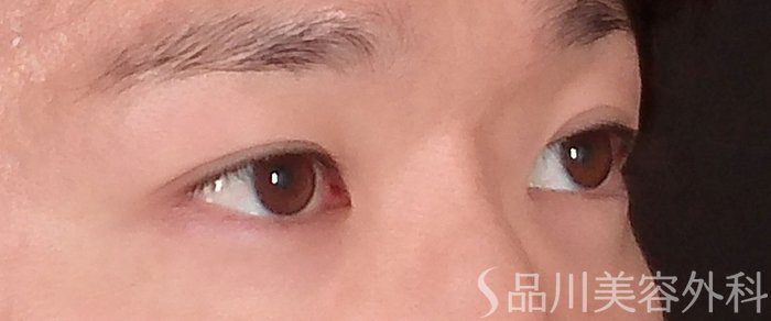 症例NO.72896のBEFORE写真