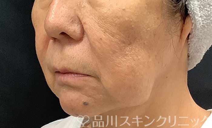 症例NO.67983のBEFORE写真