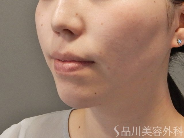 症例NO.74562のBEFORE写真