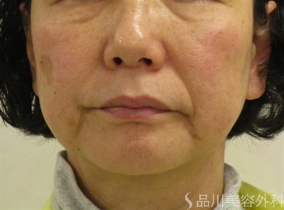 症例NO.48040のBEFORE写真