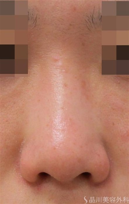 症例NO.43591のBEFORE写真