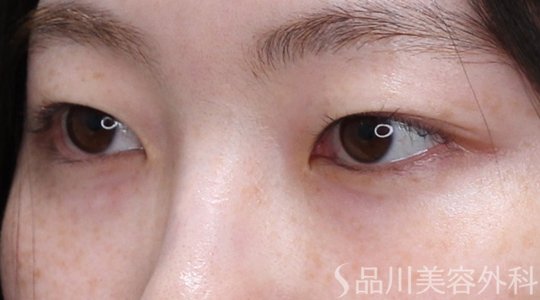 症例NO.74368のBEFORE写真