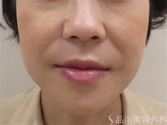 症例NO.36524のBEFORE写真