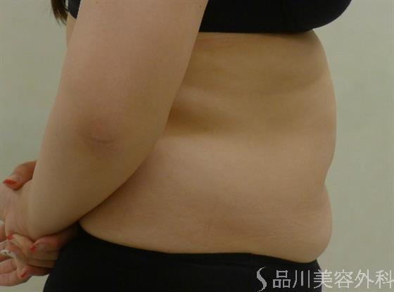 症例NO.42177のBEFORE写真