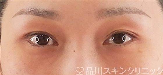 症例NO.58250のBEFORE写真