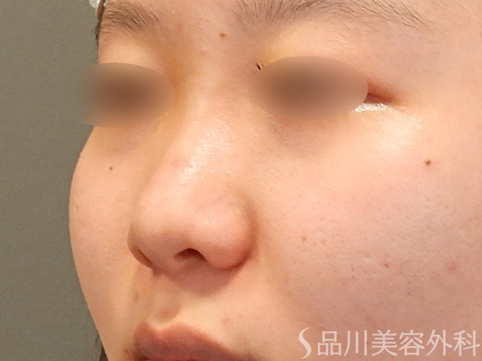 症例NO.71910のBEFORE写真