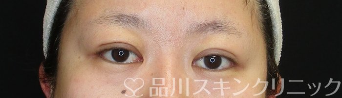 症例NO.72646のAFTER写真