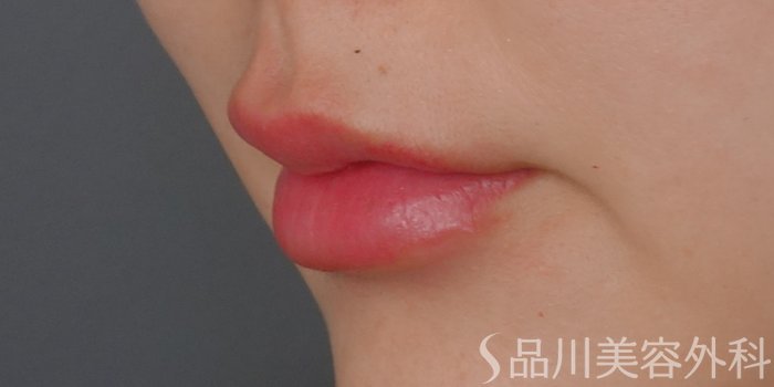 症例NO.71763のAFTER写真