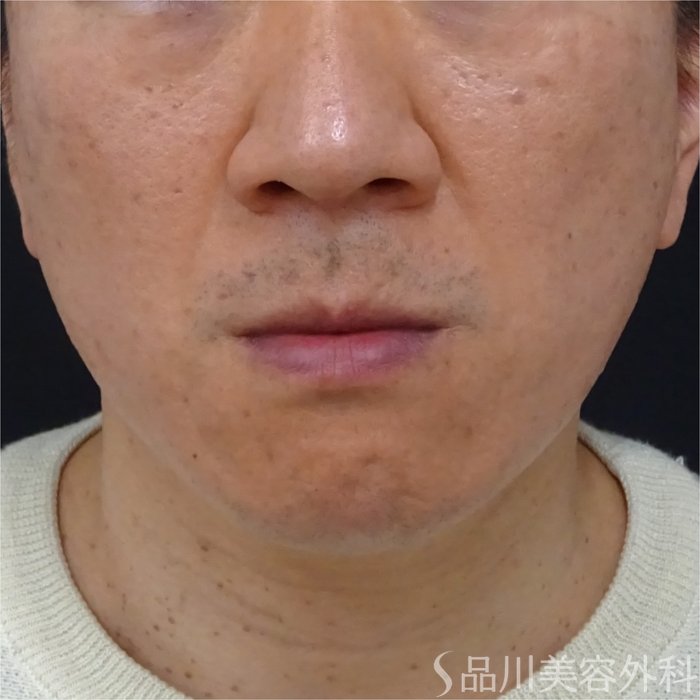 症例NO.69057のBEFORE写真
