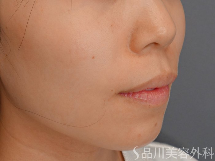 症例NO.73404のAFTER写真