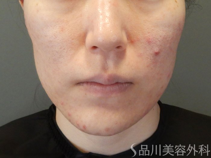 症例NO.65248のBEFORE写真
