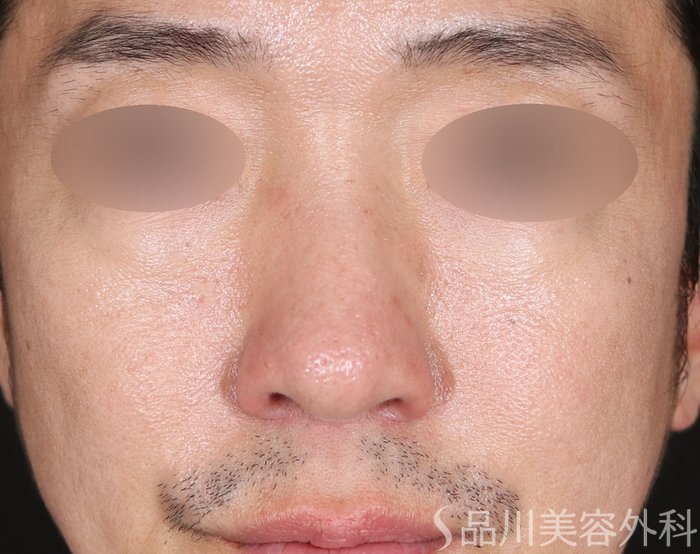 症例NO.71673のBEFORE写真