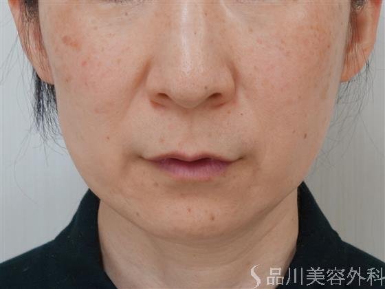 症例NO.34641のBEFORE写真
